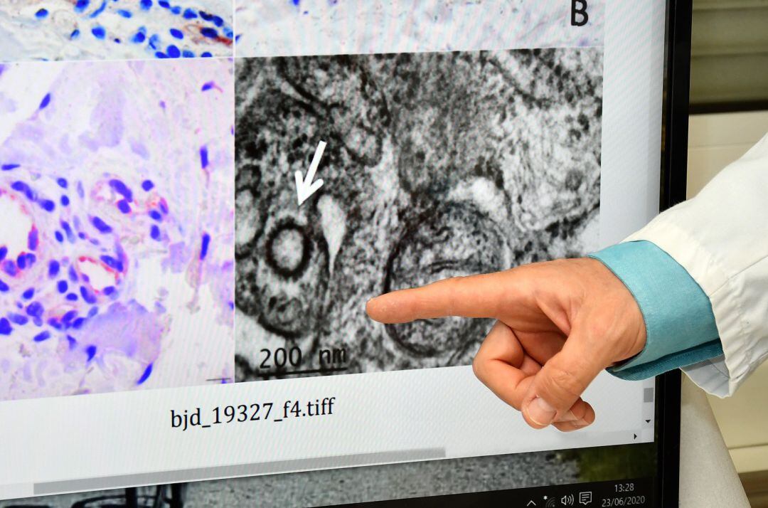 Los investigadores han conseguido “fotografiar” al virus en la piel, gracias a las biopsias realizadas en lesiones de tipo sabañones en niños (muchos de ellos habían dado negativo en la PCR)