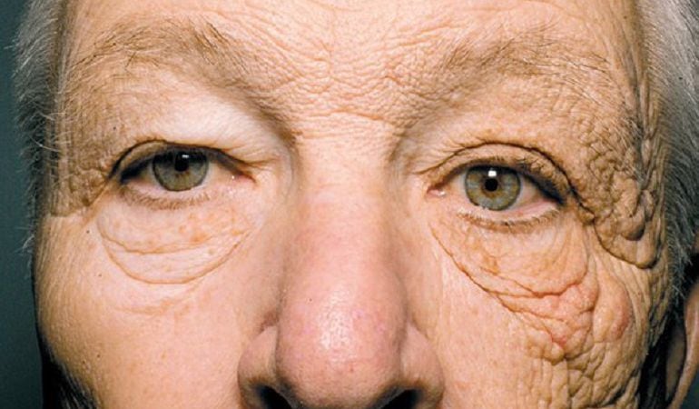 El rostro que muestra los efectos del sol en la piel