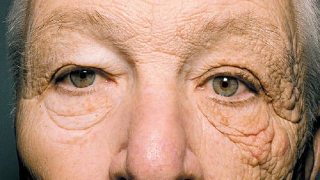 El rostro que muestra los efectos del sol en la piel