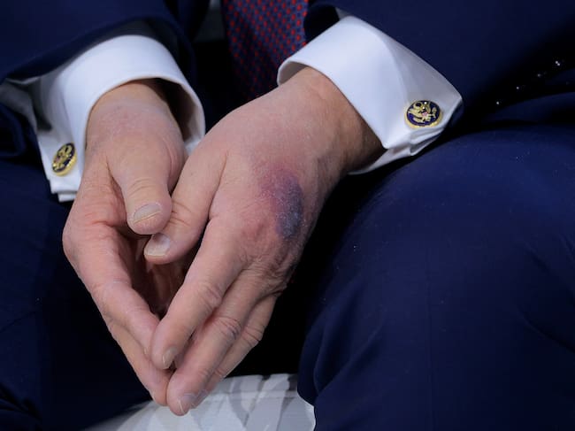 La mano amoratada de Donald Trump en Davos