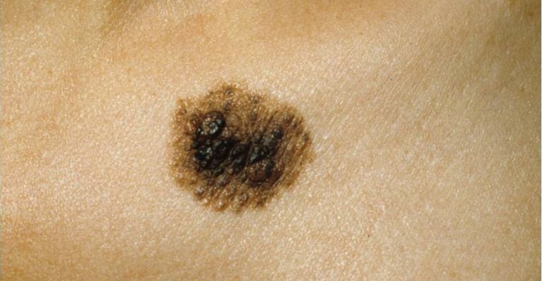 Imatge d'un nevus clínicament atípic (color heterogeni i de grans dimensions)