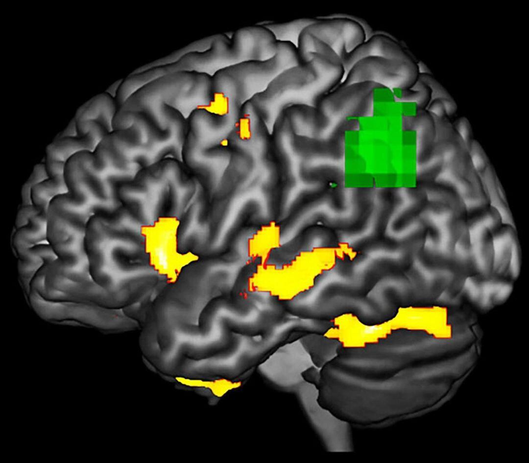 Imagen de un cerebro afectado por un proceso de neurodegeneración. 
 