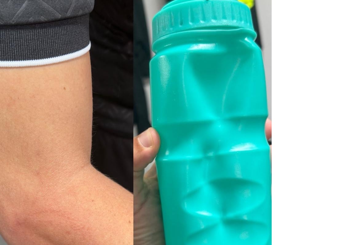 Imagen del bidón y el impacto en el codo del juez de línea