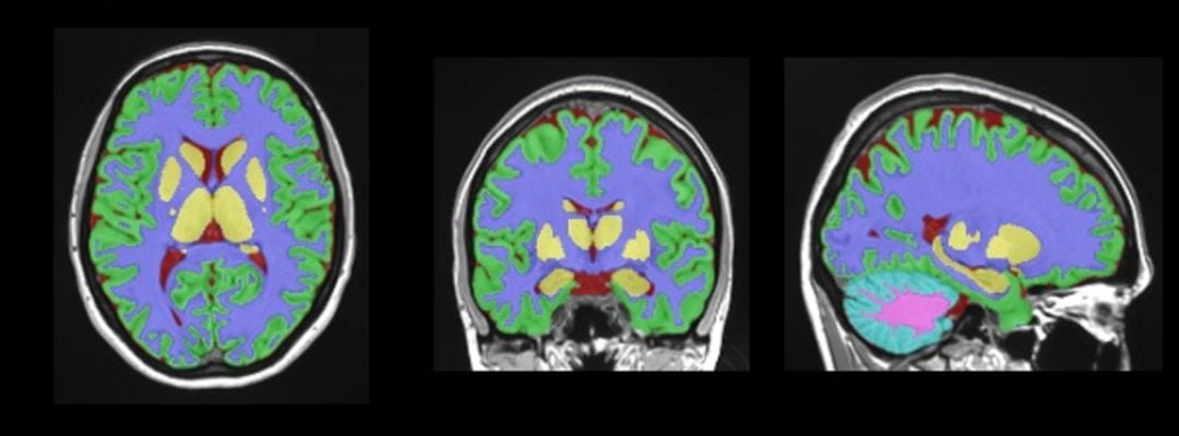 Investigadores de la UPV y CNRS de Francia crean vol2Brain, una nueva herramienta online para el estudio del cerebro