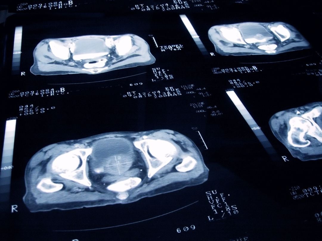 El trabajo se ha realizado sobre cerca de medio millón de certificados de defunción por cánceres urológicos (cáncer de próstata, cáncer de vejiga y cáncer de riñón) entre los años 2004 y 2013 en los 14 municipios con mayor población de la Comunidad de Madrid.