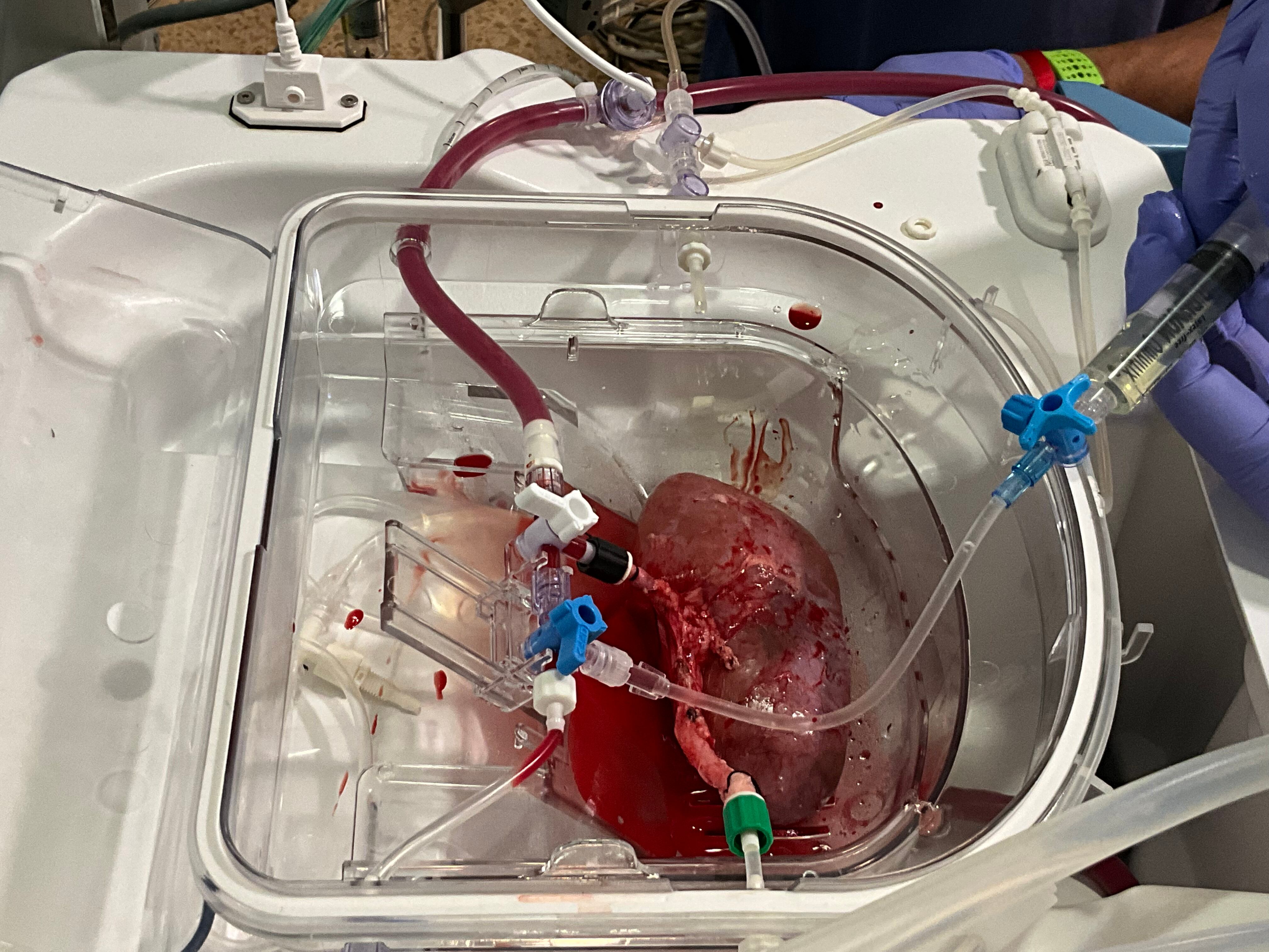 Riñón porcino conectado a la máquina de perfusión normotérmica. Este dispositivo permite preservar el riñón vivo y oxigenado de manera ex vivo (fuera del cuerpo). La imagen muestra el momento de la infusión de los organoides renales humanos en el riñón porcino.Crédito: Instituto de Bioingeniería de Cataluña