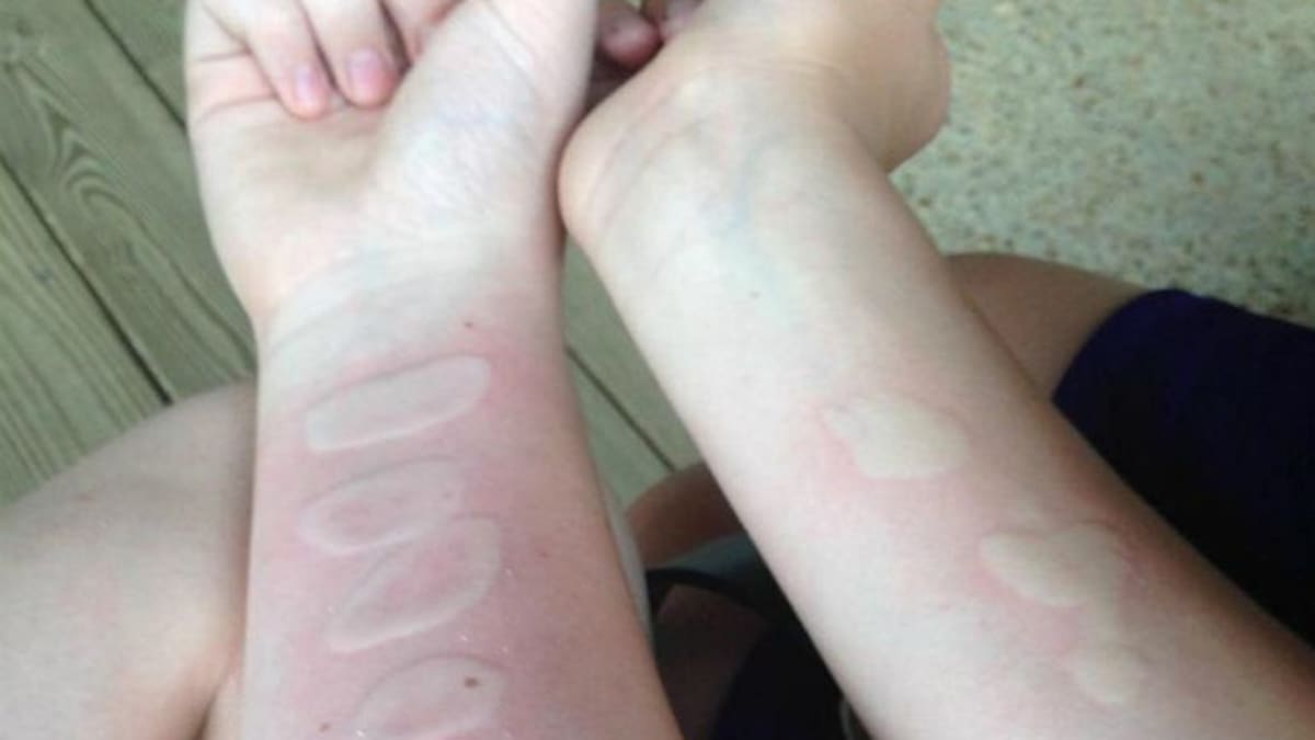 El Materno alerta del "reto del paracetamol": niños intoxicados graves tras desafíos virales en redes