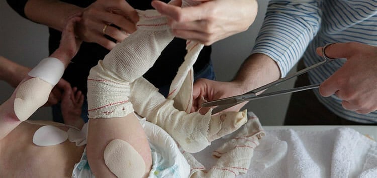 Niño afectado por la enfermedad Piel de mariposa