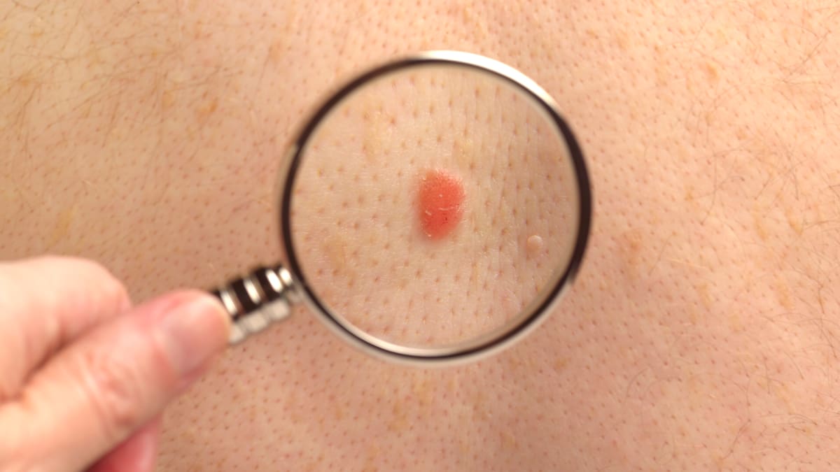 La regla del "patito feo" para saber si un lunar es peligroso o no (y por qué los verrugosos no deberían preocuparte)
