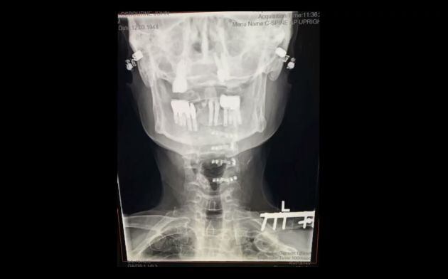 Radiografía del cuello de Ozzy Osbourne tras la instalación de prótesis metálicas.
