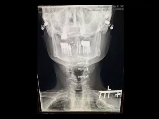 Radiografía del cuello de Ozzy Osbourne tras la instalación de prótesis metálicas.