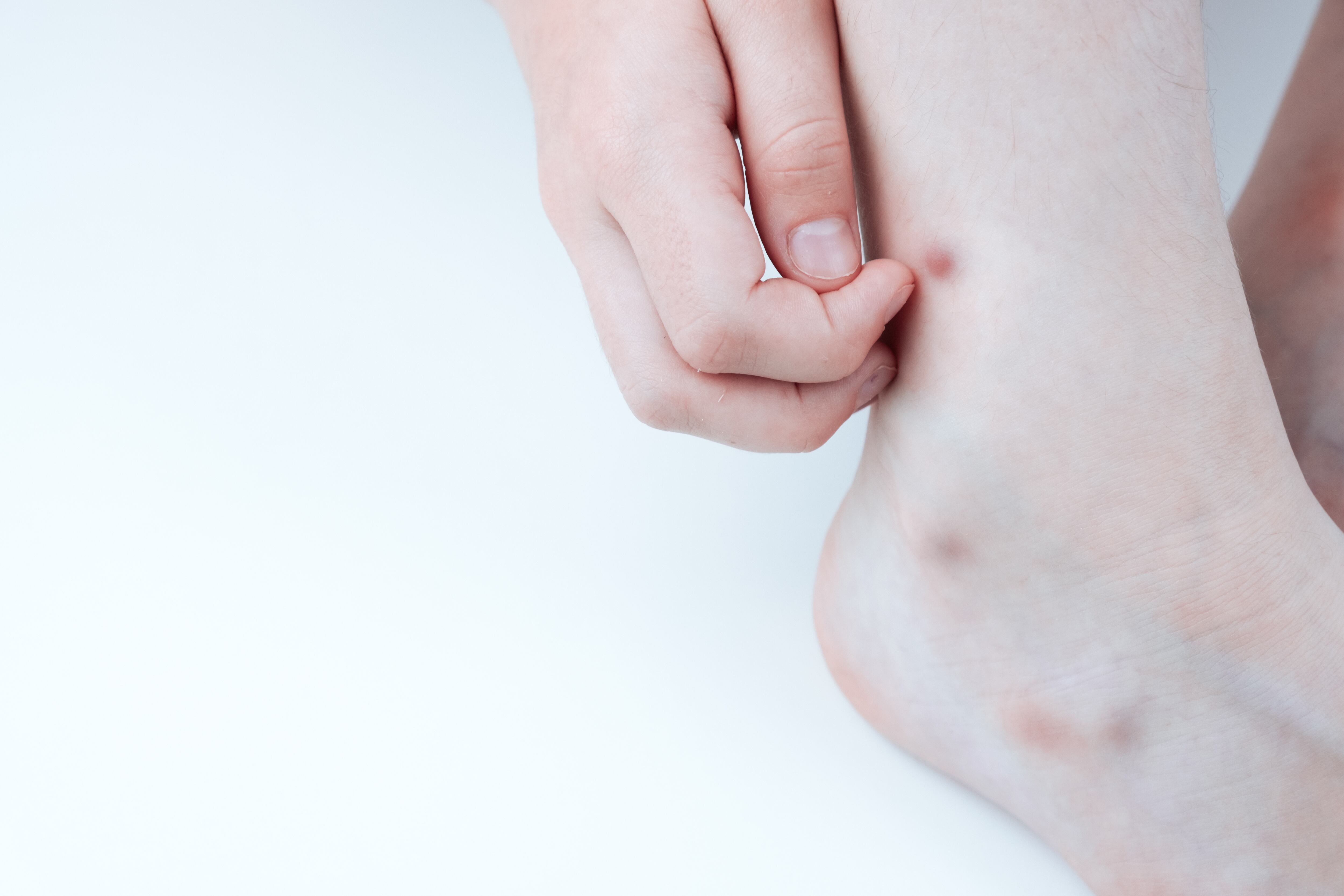 Imagen de archivo de unas picaduras comunes