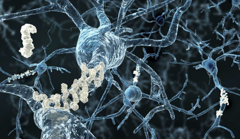 Neuronas recubiertas de proteína amiloide