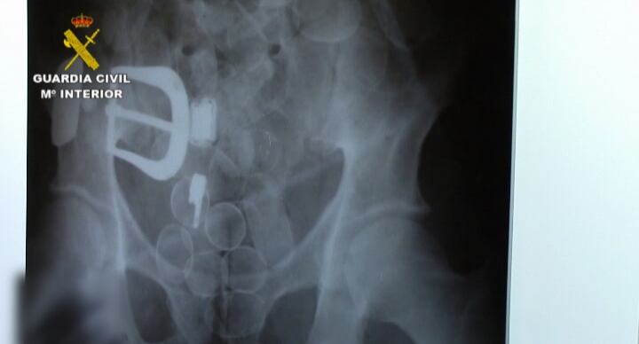 Radiografía de la droga oculta en el cádaver del "mulero" asesinado