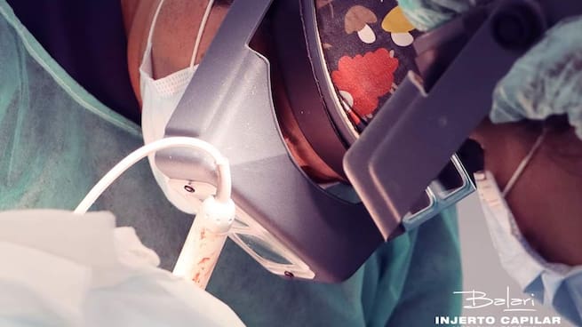 Reportaje | Turquía, la meca del injerto capilar sin anestesia ni cirujanos