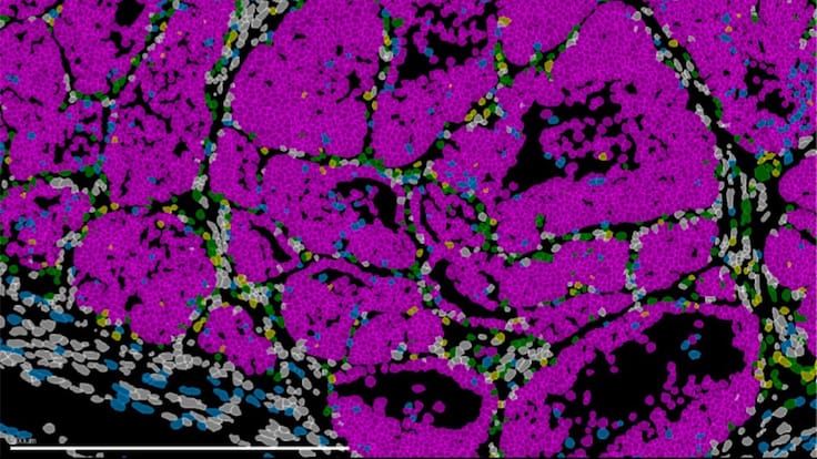 Ángela Nieto, investigadora del CSIC, habla en Hoy por Hoy Alicante del último estudio sobre el cáncer de mama y las células encargadas de la metástasis