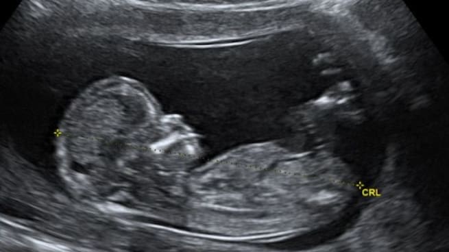 El verdadero latido de un aborto: el de un derecho