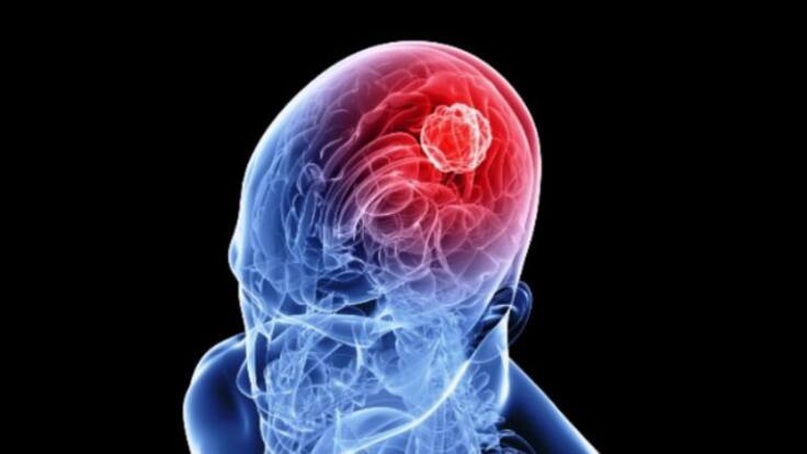 Entrevista con el coordinador de la Unidad de Ictus del Hospital San Pedro, Francisco Julián (29/10/2023)