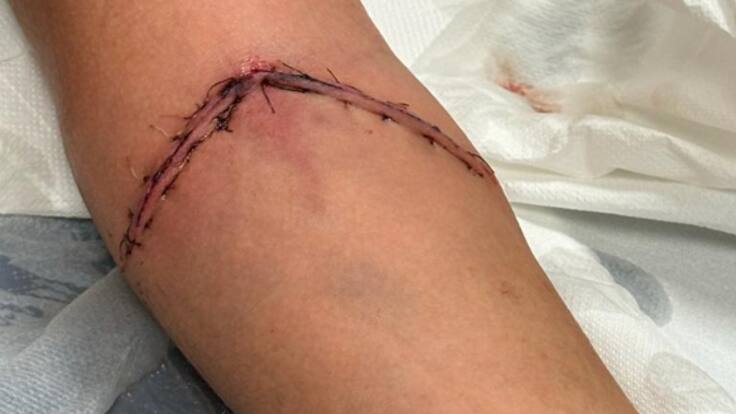 Sufre graves heridas al engancharse con un cerramiento de un parque en mal estado