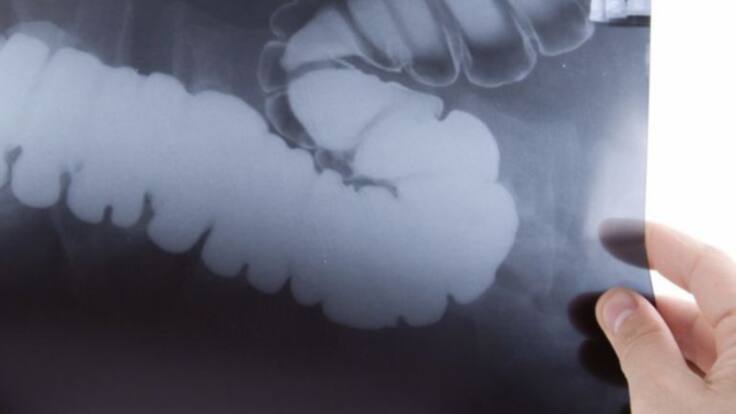 Preocupante aumento del cáncer colorrectal en menores de 50 años