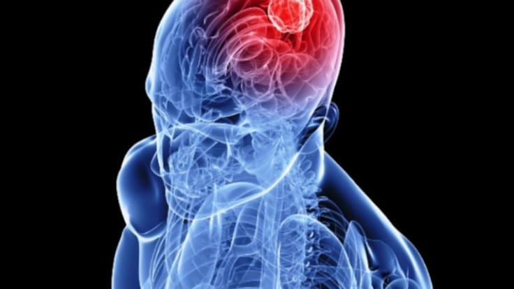 "El tiempo es vida": el invento español que acelera el diagnóstico de ictus