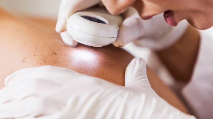 Cada año se operan un millar de personas diagnosticadas de cáncer de piel en Ibiza