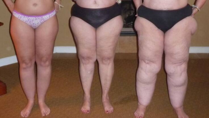 El cáncer o el linfedema: enfermedades que se agravan con el calor - Hora 14 Aragón (07/08/2024)