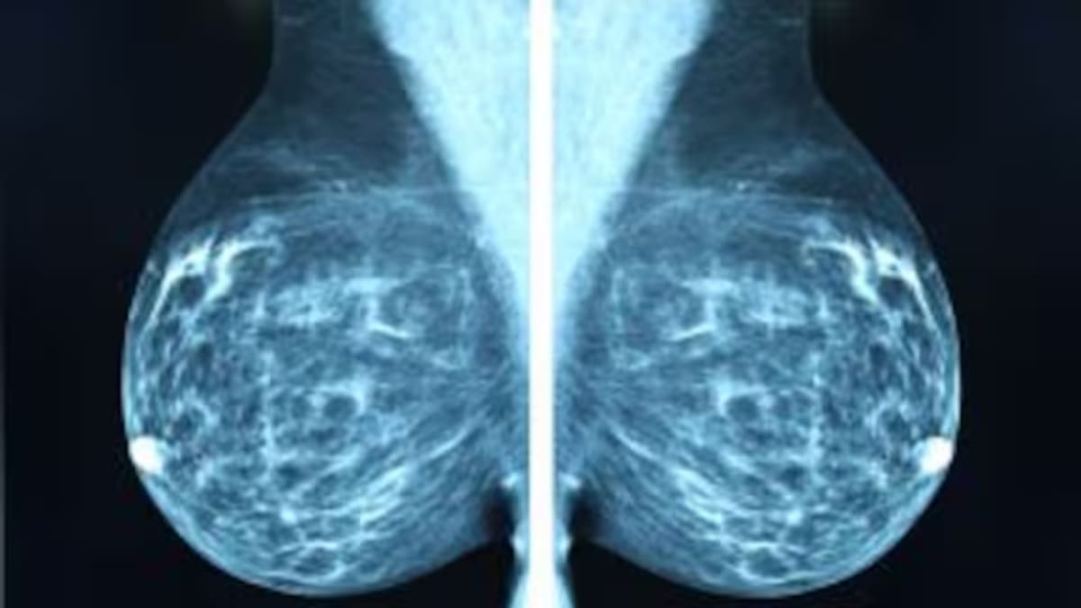 La Junta dejó de informar a las mujeres con mamografías sospechosas desde abril de 2021