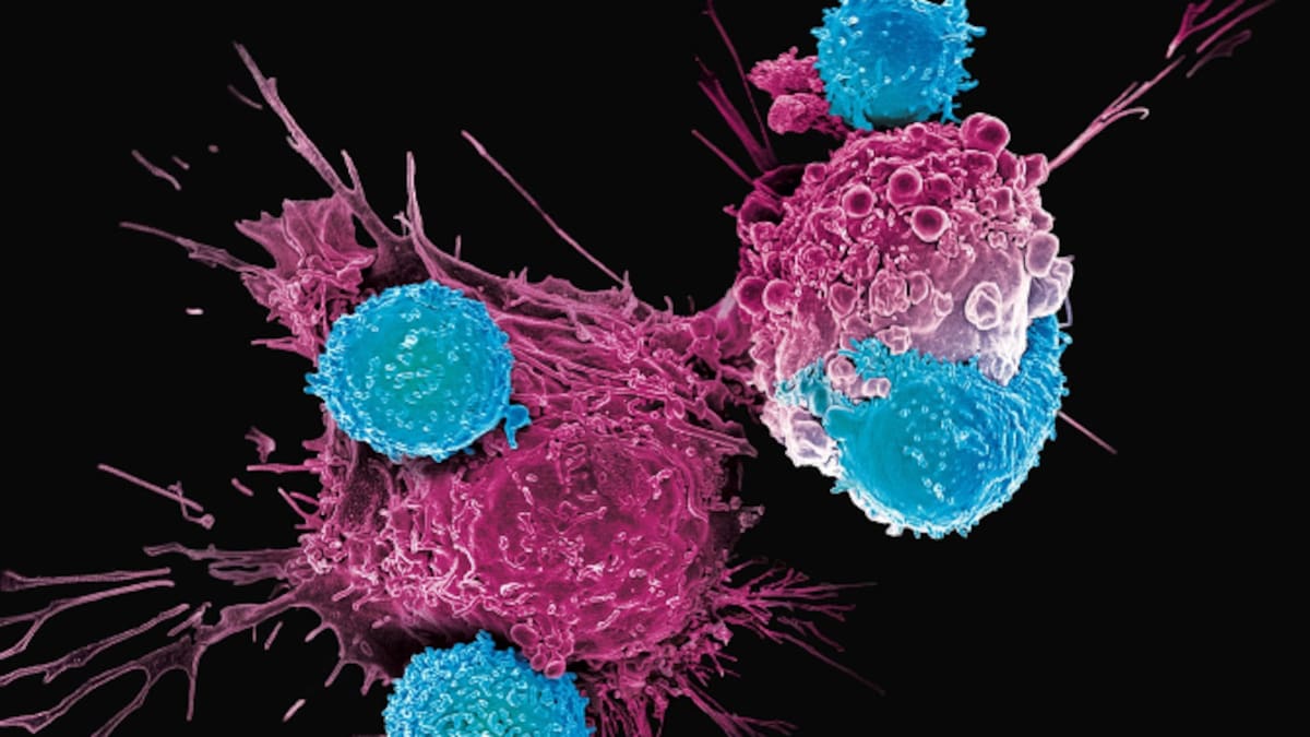 La ciencia pública salva vidas: cómo la terapia CAR-T está revolucionando el tratamiento de la leucemia