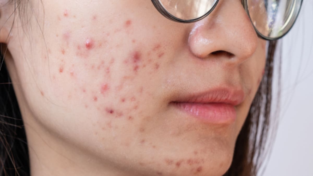 La clave para controlar el acné en la adolescencia sin recurrir al Dercutane