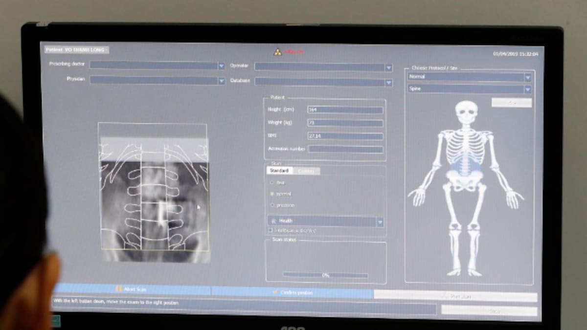 Osteoporosis: claves para reconocer esta enfermedad y tips para prevenirla