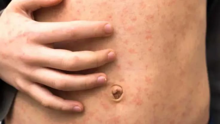 La Rebotica: El sarampión