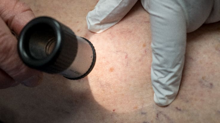 La saturación en la Dermatología española