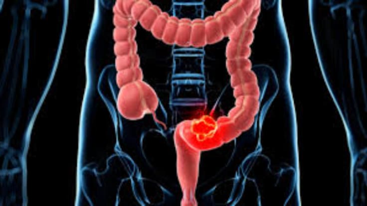Hoy por Hoy Zaragoza y el cáncer de colón (31/03/26)